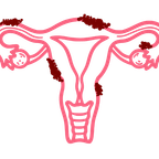 Endometriose